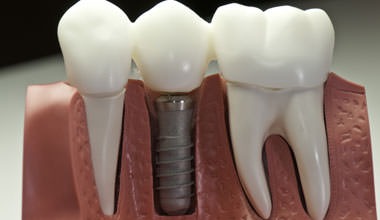 Ipswich Dental Implants - M L Crowe Dental Practices