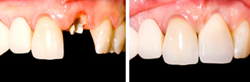 M L Crowe Ipswich Dental Implants