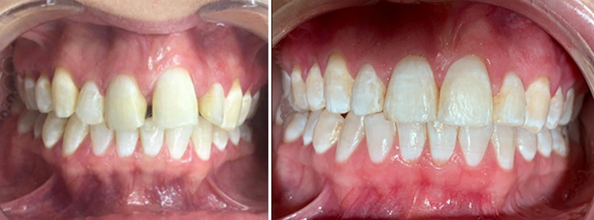 Ipswich Orthodontics at M L Crowe Dental Practices
